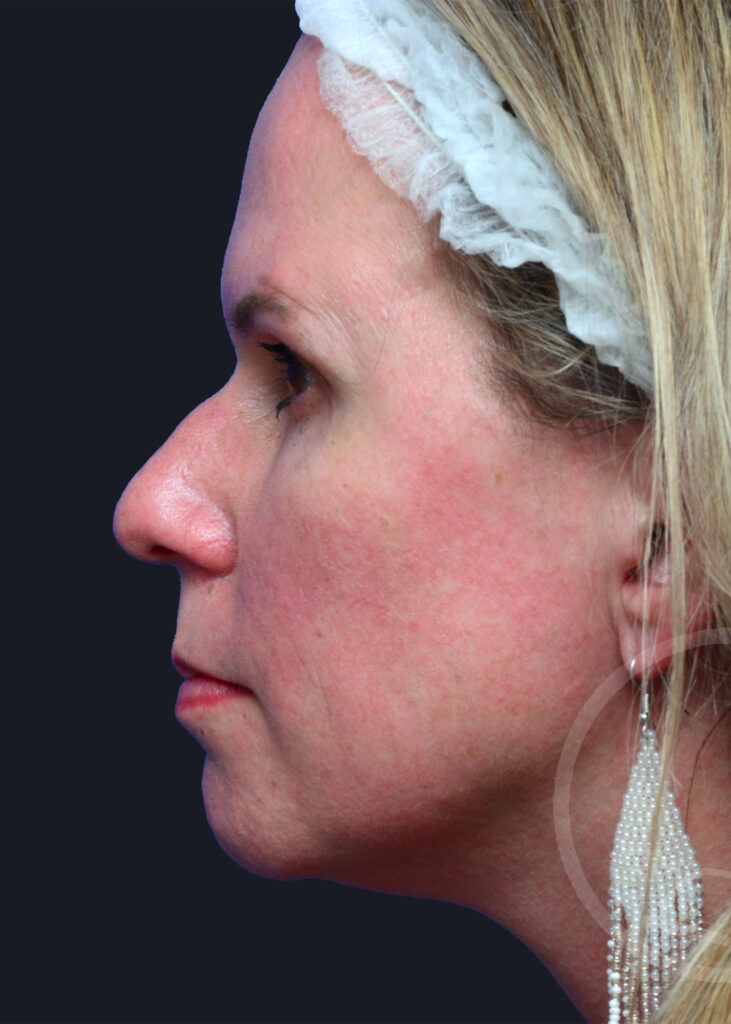 Plastic Surgery Before and After Pictures in Jacksonville, FL - Garcia Facial Plastic Surgery