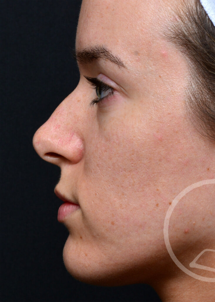 Plastic Surgery Before and After Pictures in Jacksonville, FL - Garcia Facial Plastic Surgery