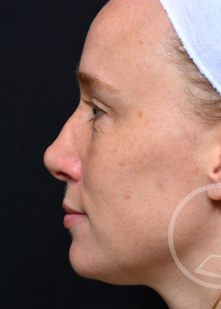 Plastic Surgery Before and After Pictures in Jacksonville, FL - Garcia Facial Plastic Surgery