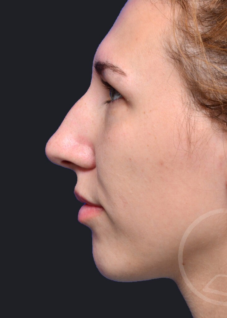 Plastic Surgery Before and After Pictures in Jacksonville, FL - Garcia Facial Plastic Surgery