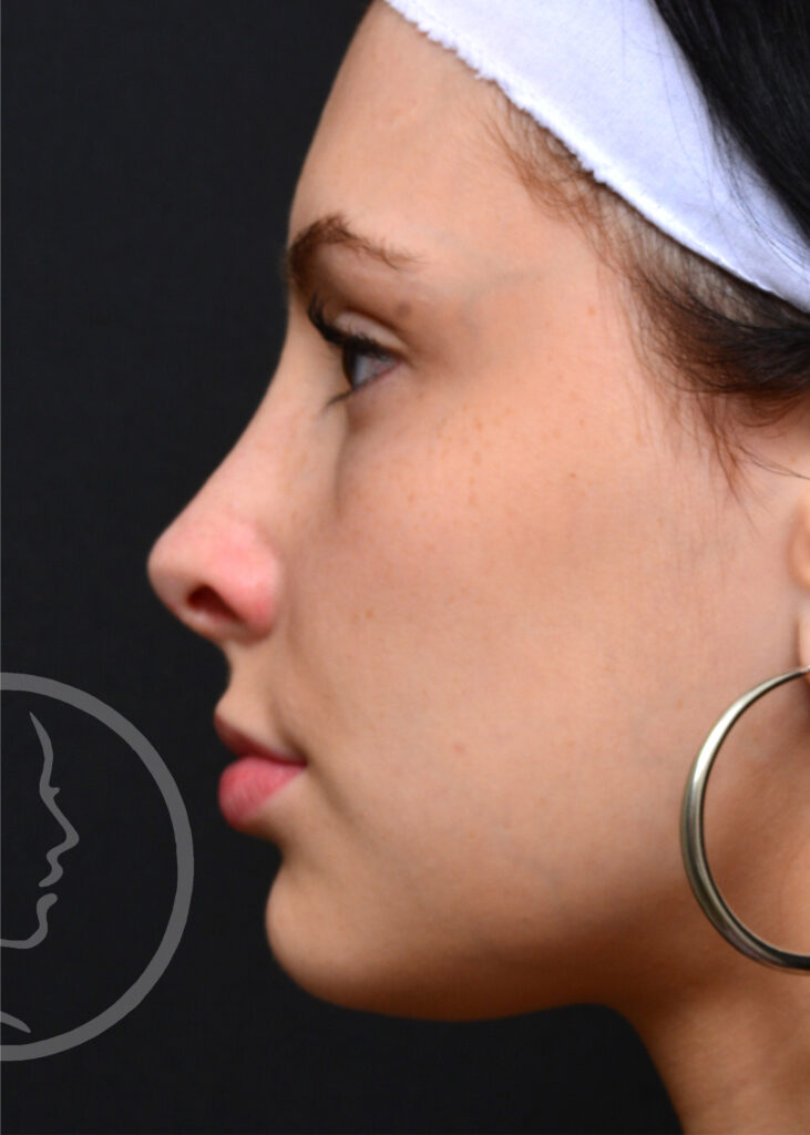 Plastic Surgery Before and After Pictures in Jacksonville, FL - Garcia Facial Plastic Surgery