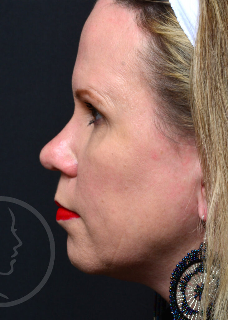 Plastic Surgery Before and After Pictures in Jacksonville, FL - Garcia Facial Plastic Surgery