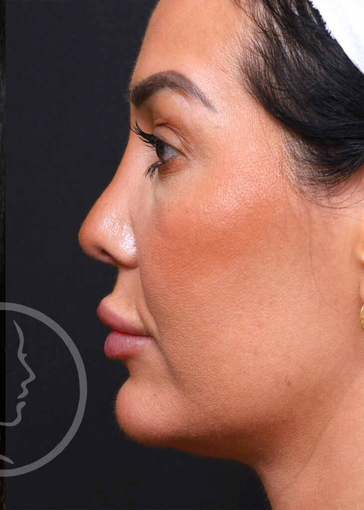 Plastic Surgery Before and After Pictures in Jacksonville, FL - Garcia Facial Plastic Surgery