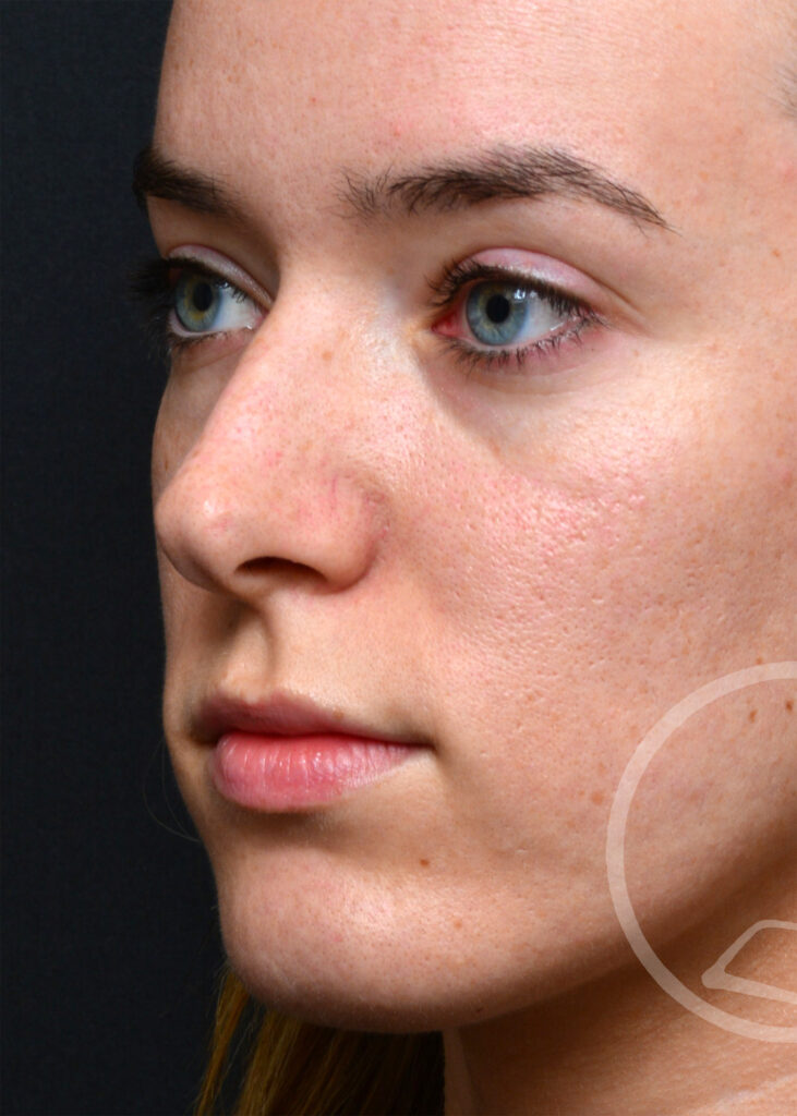 Plastic Surgery Before and After Pictures in Jacksonville, FL - Garcia Facial Plastic Surgery