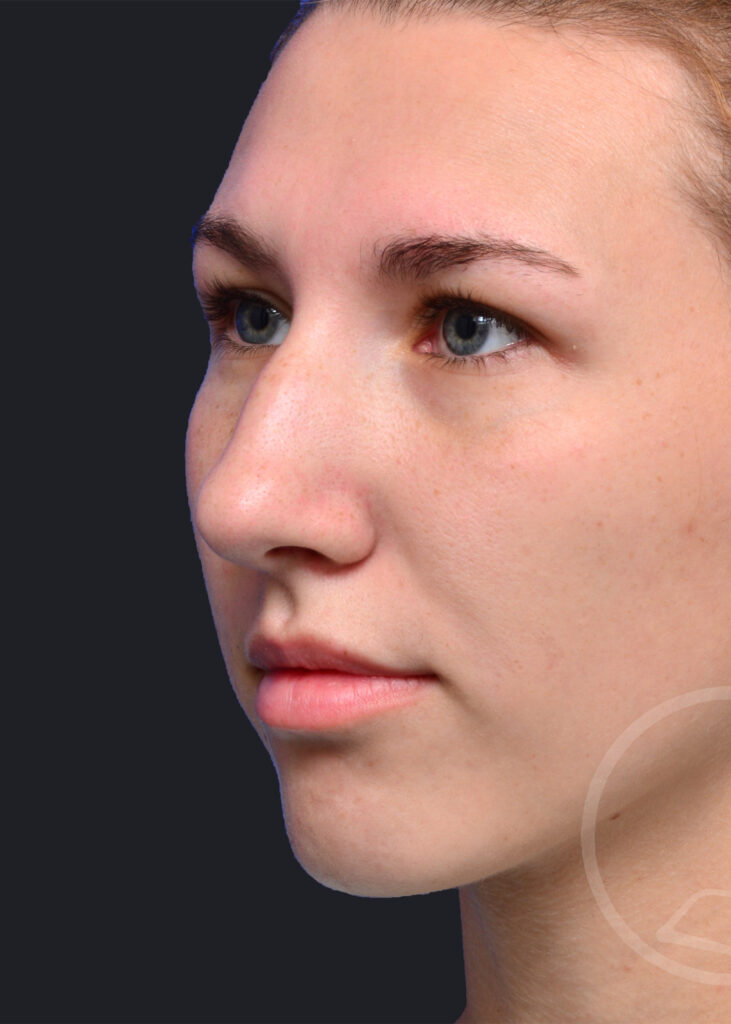 Plastic Surgery Before and After Pictures in Jacksonville, FL - Garcia Facial Plastic Surgery