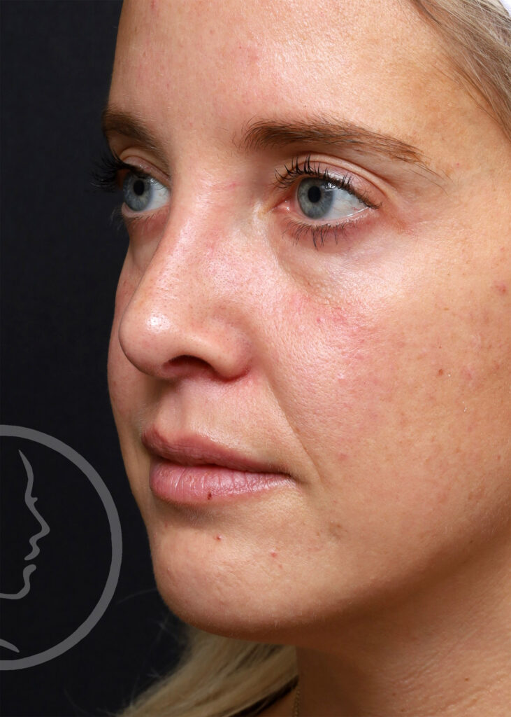 Plastic Surgery Before and After Pictures in Jacksonville, FL - Garcia Facial Plastic Surgery