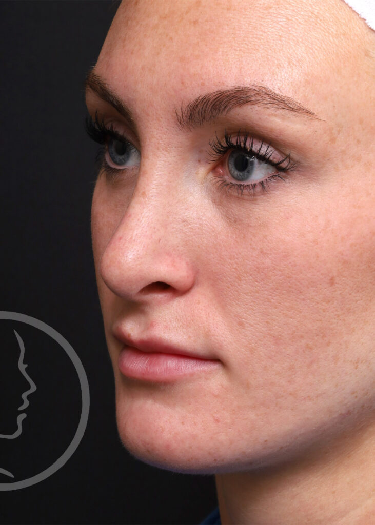Plastic Surgery Before and After Pictures in Jacksonville, FL - Garcia Facial Plastic Surgery