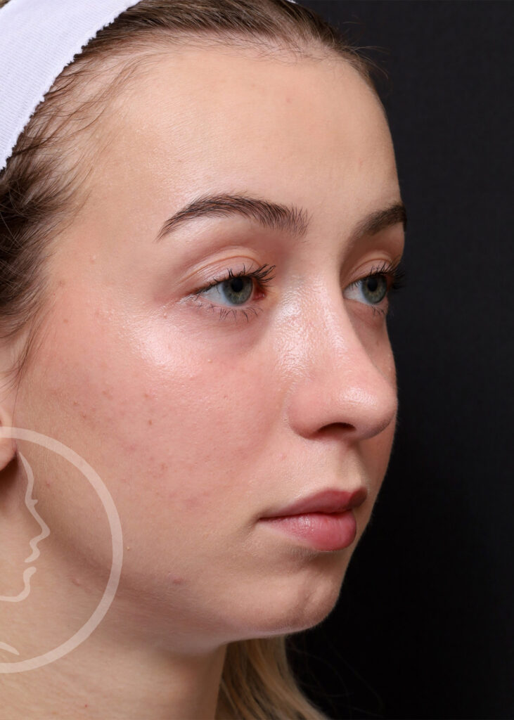 Plastic Surgery Before and After Pictures in Jacksonville, FL - Garcia Facial Plastic Surgery