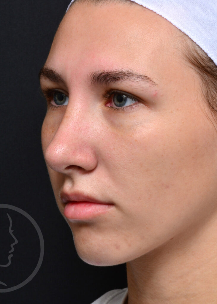 Plastic Surgery Before and After Pictures in Jacksonville, FL - Garcia Facial Plastic Surgery
