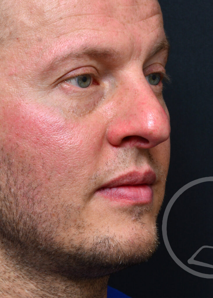 Plastic Surgery Before and After Pictures in Jacksonville, FL - Garcia Facial Plastic Surgery