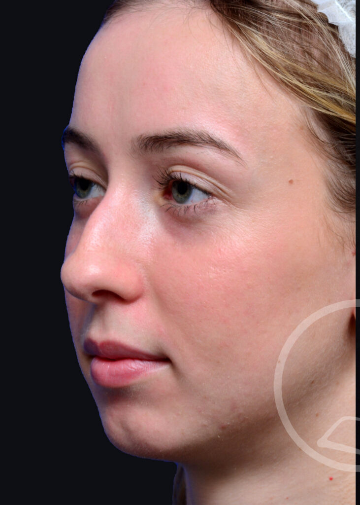 Plastic Surgery Before and After Pictures in Jacksonville, FL - Garcia Facial Plastic Surgery