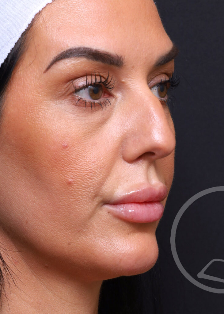 Plastic Surgery Before and After Pictures in Jacksonville, FL - Garcia Facial Plastic Surgery