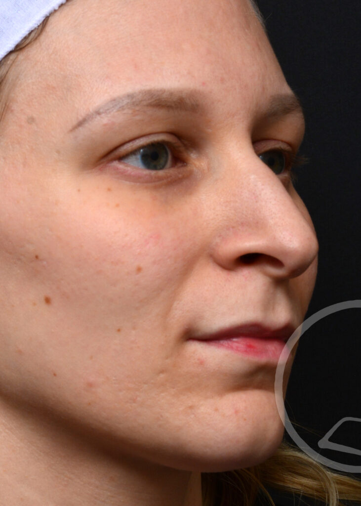 Plastic Surgery Before and After Pictures in Jacksonville, FL - Garcia Facial Plastic Surgery