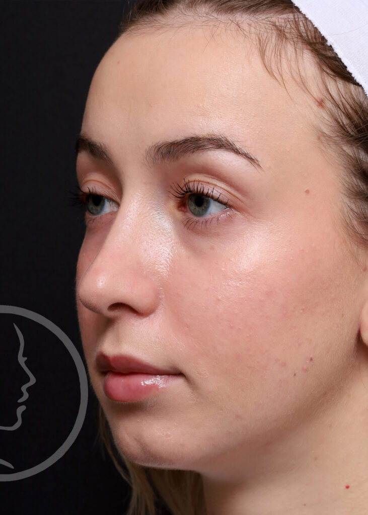 Plastic Surgery Before and After Pictures in Jacksonville, FL - Garcia Facial Plastic Surgery