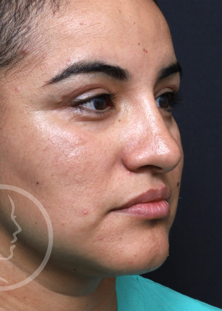 Plastic Surgery Before and After Pictures in Jacksonville, FL - Garcia Facial Plastic Surgery