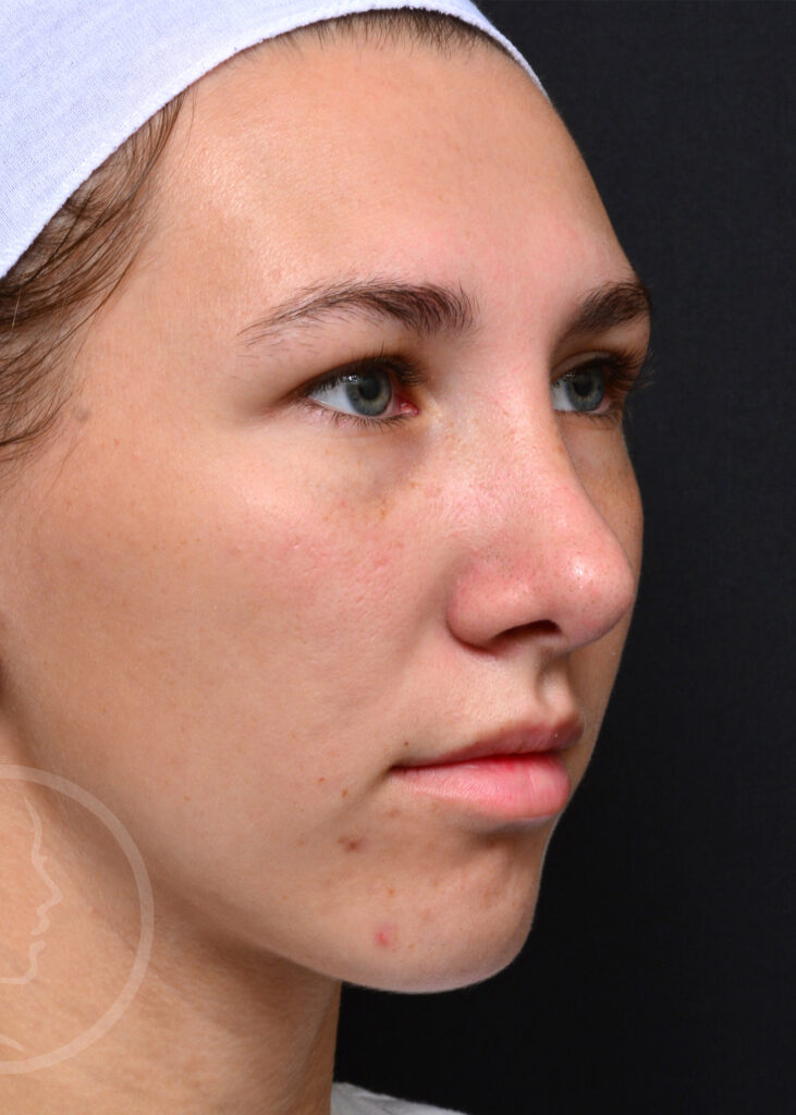 Plastic Surgery Before and After Pictures in Jacksonville, FL - Garcia Facial Plastic Surgery