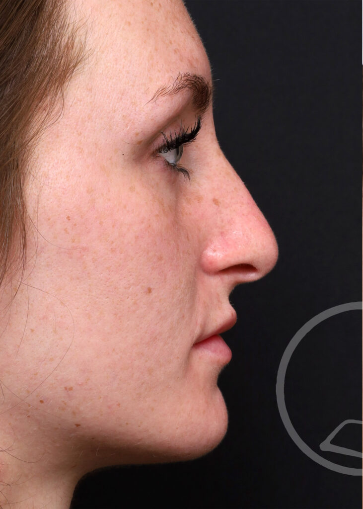 Plastic Surgery Before and After Pictures in Jacksonville, FL - Garcia Facial Plastic Surgery