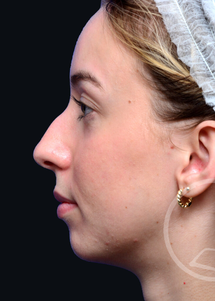 Plastic Surgery Before and After Pictures in Jacksonville, FL - Garcia Facial Plastic Surgery