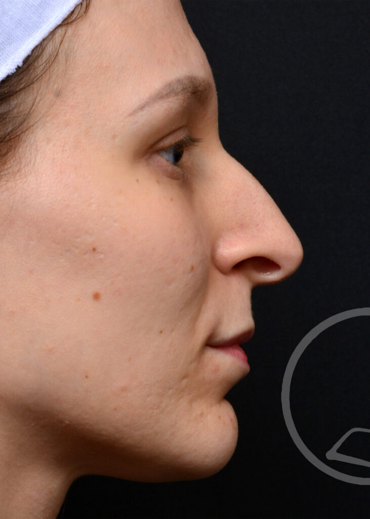 Plastic Surgery Before and After Pictures in Jacksonville, FL - Garcia Facial Plastic Surgery