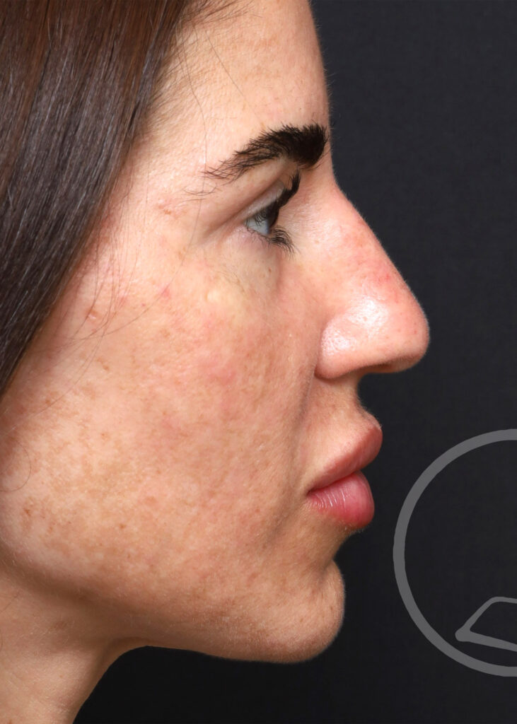 Plastic Surgery Before and After Pictures in Jacksonville, FL - Garcia Facial Plastic Surgery