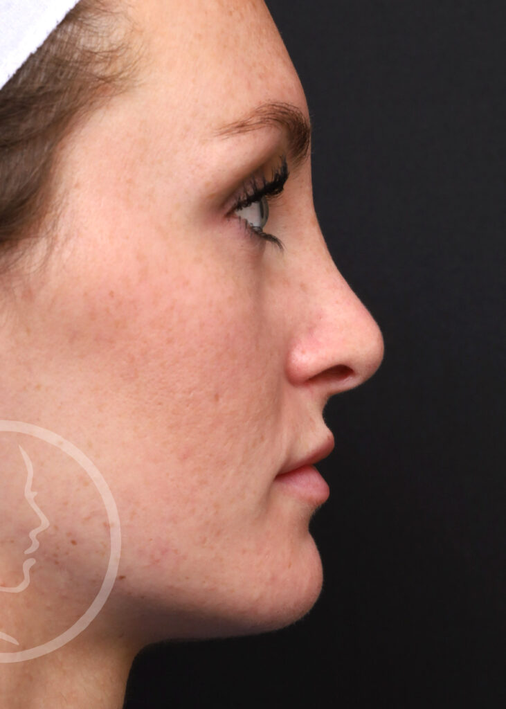 Plastic Surgery Before and After Pictures in Jacksonville, FL - Garcia Facial Plastic Surgery