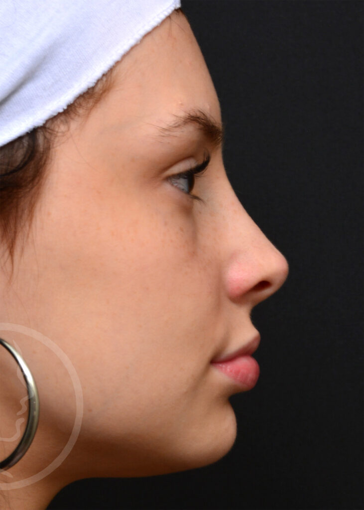 Plastic Surgery Before and After Pictures in Jacksonville, FL - Garcia Facial Plastic Surgery