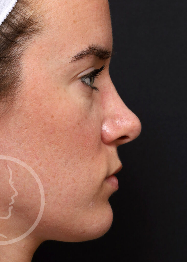 Plastic Surgery Before and After Pictures in Jacksonville, FL - Garcia Facial Plastic Surgery