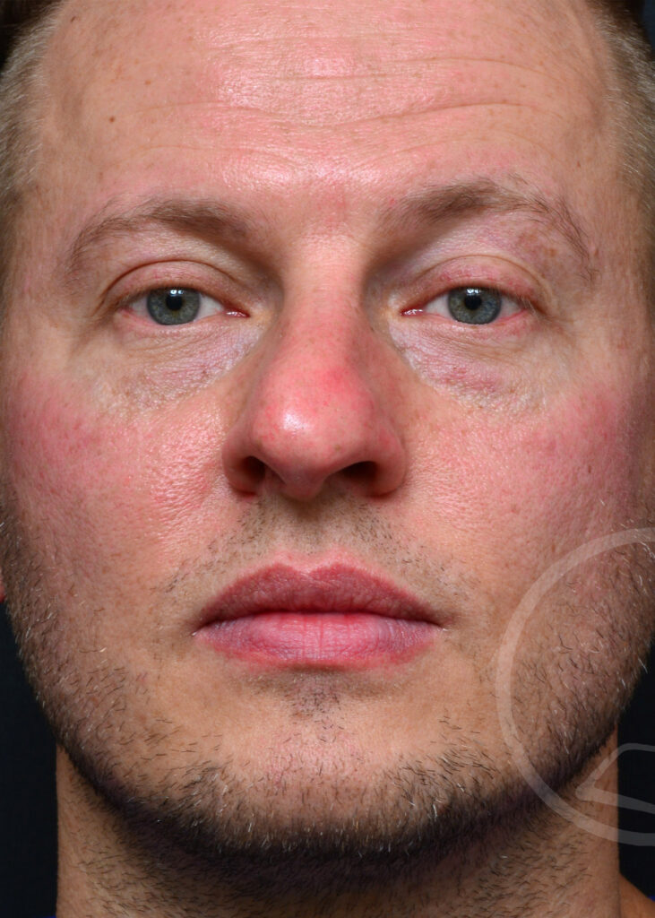 Plastic Surgery Before and After Pictures in Jacksonville, FL - Garcia Facial Plastic Surgery