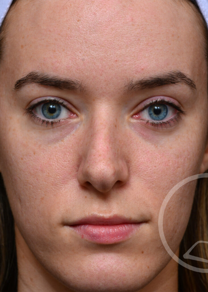 Plastic Surgery Before and After Pictures in Jacksonville, FL - Garcia Facial Plastic Surgery