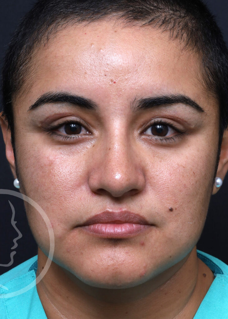 Plastic Surgery Before and After Pictures in Jacksonville, FL - Garcia Facial Plastic Surgery