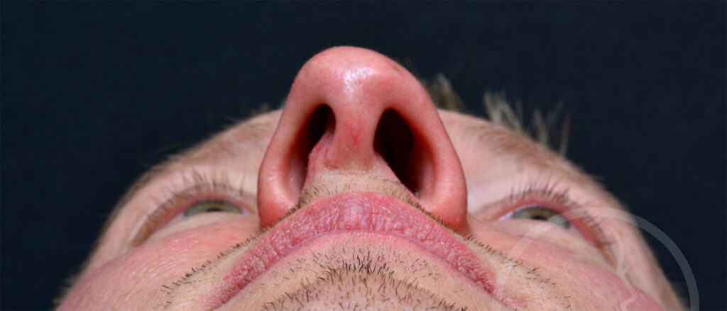 Plastic Surgery Before and After Pictures in Jacksonville, FL - Garcia Facial Plastic Surgery