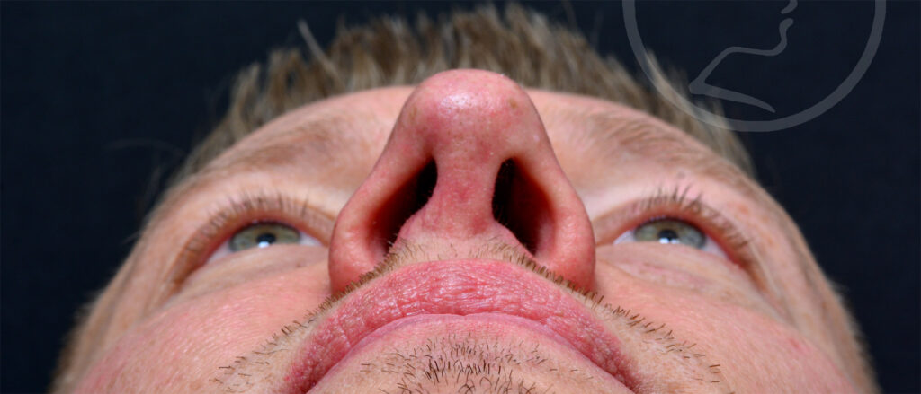 Plastic Surgery Before and After Pictures in Jacksonville, FL - Garcia Facial Plastic Surgery