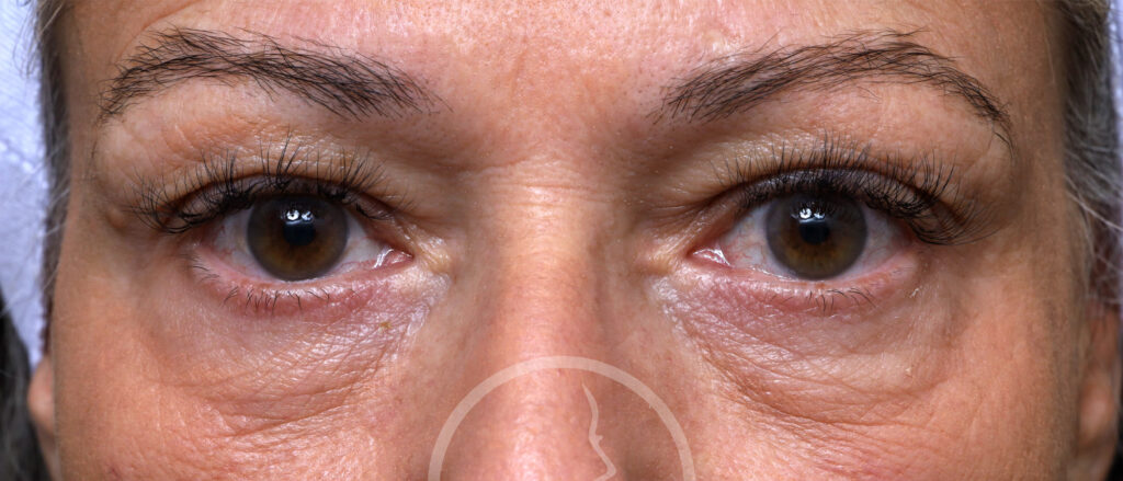 Plastic Surgery Before and After Pictures in Jacksonville, FL - Garcia Facial Plastic Surgery
