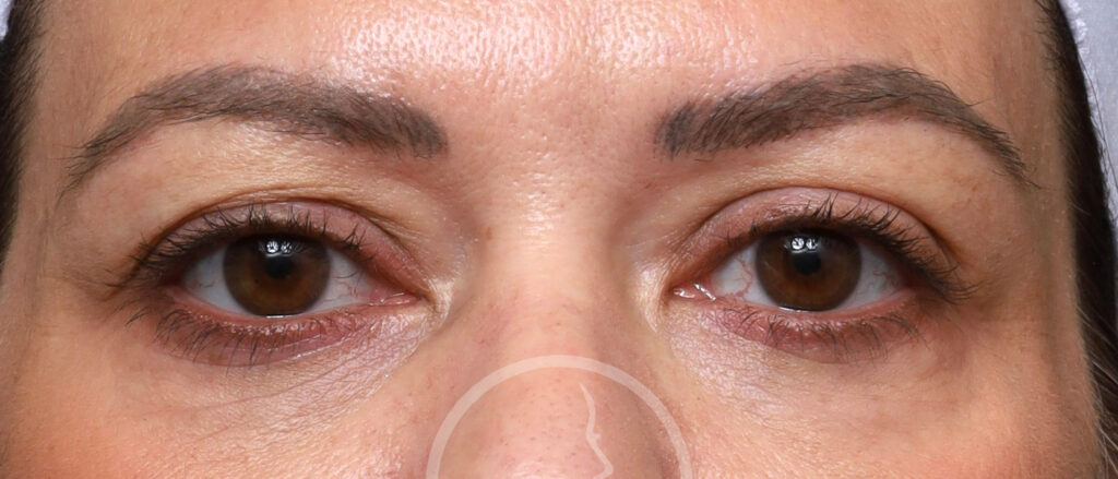 Plastic Surgery Before and After Pictures in Jacksonville, FL - Garcia Facial Plastic Surgery