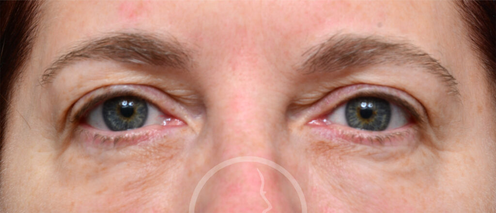 Plastic Surgery Before and After Pictures in Jacksonville, FL - Garcia Facial Plastic Surgery
