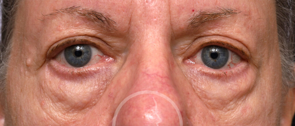 Plastic Surgery Before and After Pictures in Jacksonville, FL - Garcia Facial Plastic Surgery