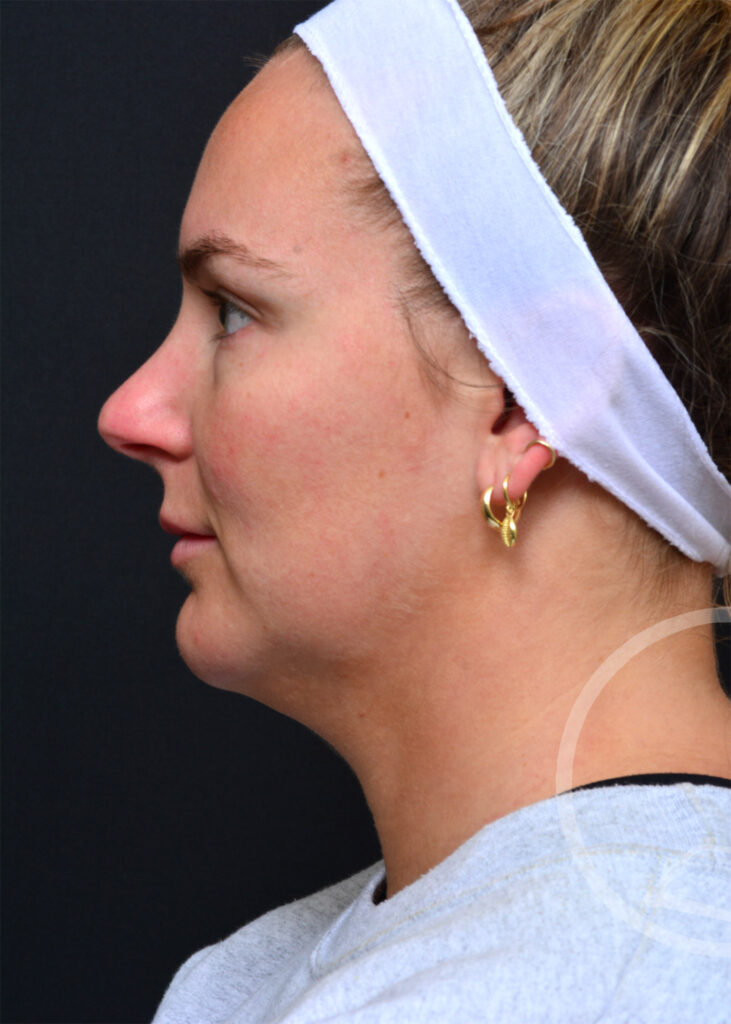Plastic Surgery Before and After Pictures in Jacksonville, FL - Garcia Facial Plastic Surgery