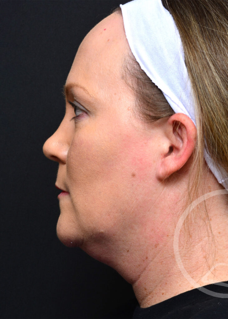Plastic Surgery Before and After Pictures in Jacksonville, FL - Garcia Facial Plastic Surgery