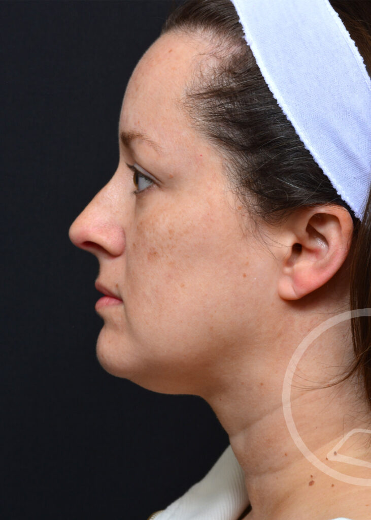 Plastic Surgery Before and After Pictures in Jacksonville, FL - Garcia Facial Plastic Surgery