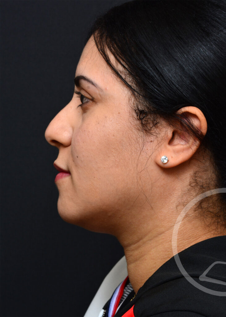 Plastic Surgery Before and After Pictures in Jacksonville, FL - Garcia Facial Plastic Surgery