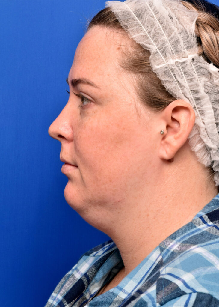 Plastic Surgery Before and After Pictures in Jacksonville, FL - Garcia Facial Plastic Surgery