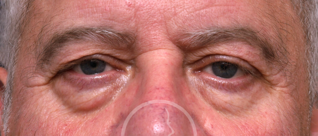 Plastic Surgery Before and After Pictures in Jacksonville, FL - Garcia Facial Plastic Surgery