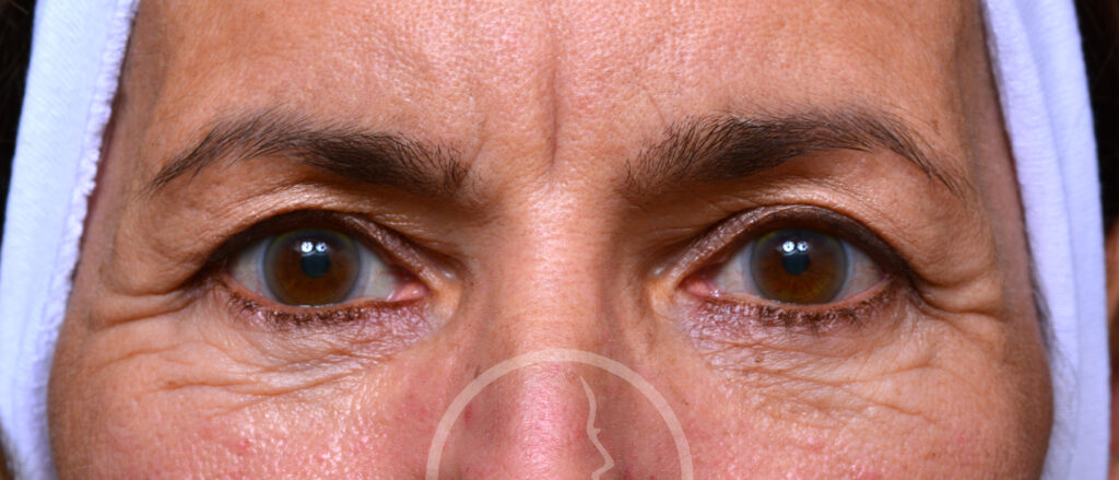 Plastic Surgery Before and After Pictures in Jacksonville, FL - Garcia Facial Plastic Surgery