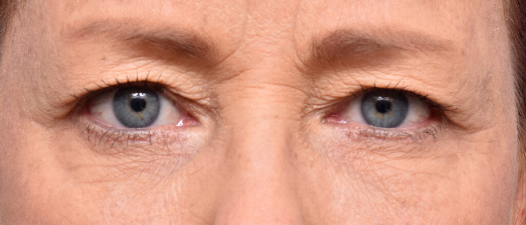 Plastic Surgery Before and After Pictures in Jacksonville, FL - Garcia Facial Plastic Surgery