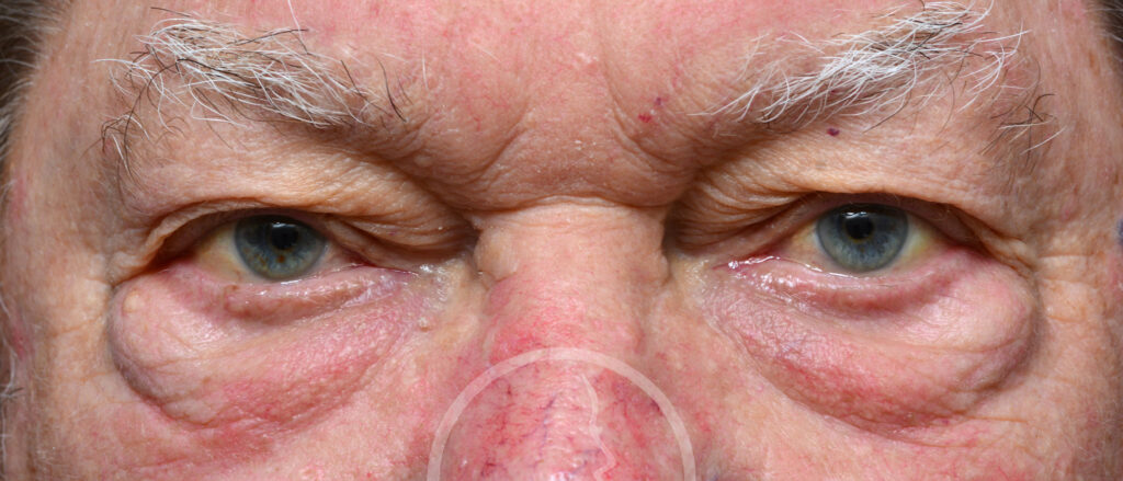 Plastic Surgery Before and After Pictures in Jacksonville, FL - Garcia Facial Plastic Surgery