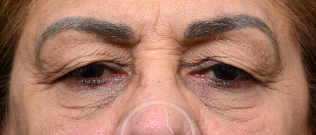 Plastic Surgery Before and After Pictures in Jacksonville, FL - Garcia Facial Plastic Surgery
