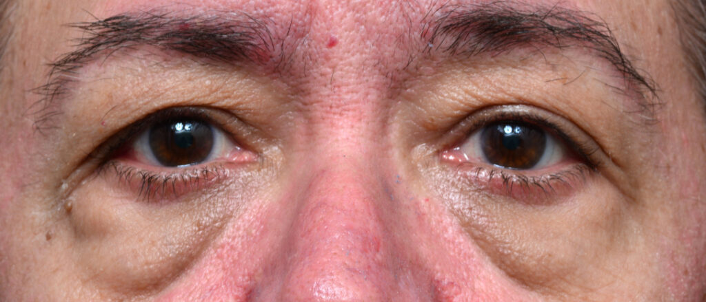 Plastic Surgery Before and After Pictures in Jacksonville, FL - Garcia Facial Plastic Surgery