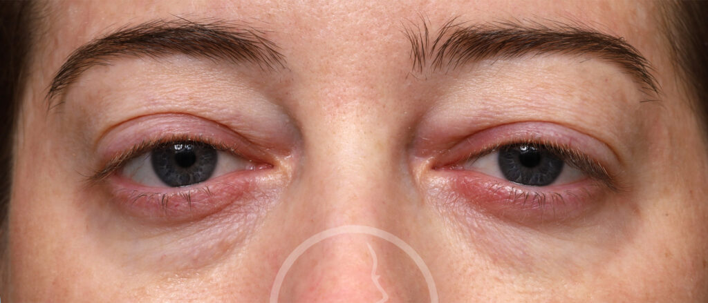 Plastic Surgery Before and After Pictures in Jacksonville, FL - Garcia Facial Plastic Surgery