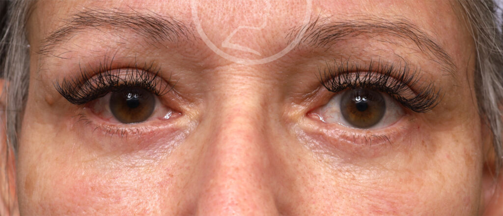 Plastic Surgery Before and After Pictures in Jacksonville, FL - Garcia Facial Plastic Surgery