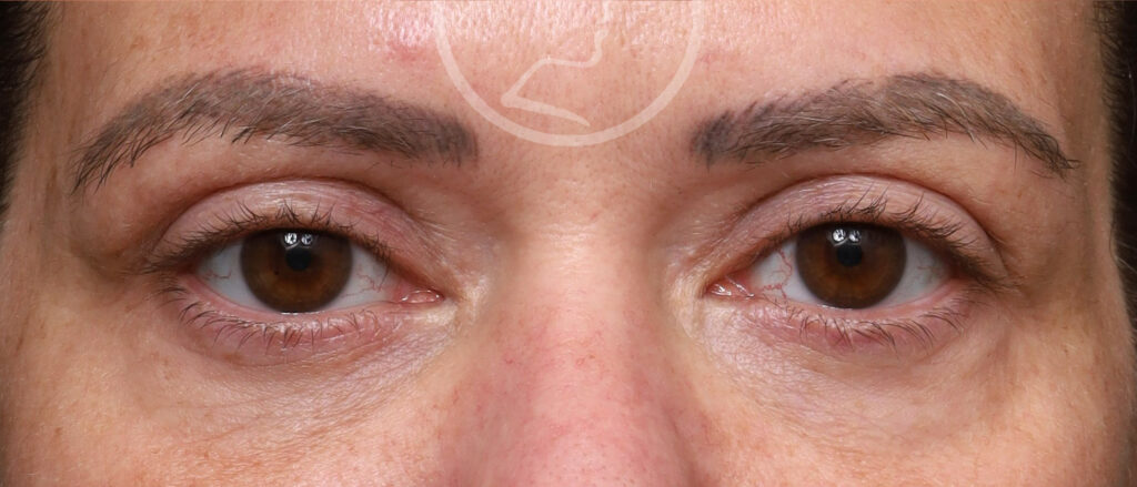 Plastic Surgery Before and After Pictures in Jacksonville, FL - Garcia Facial Plastic Surgery